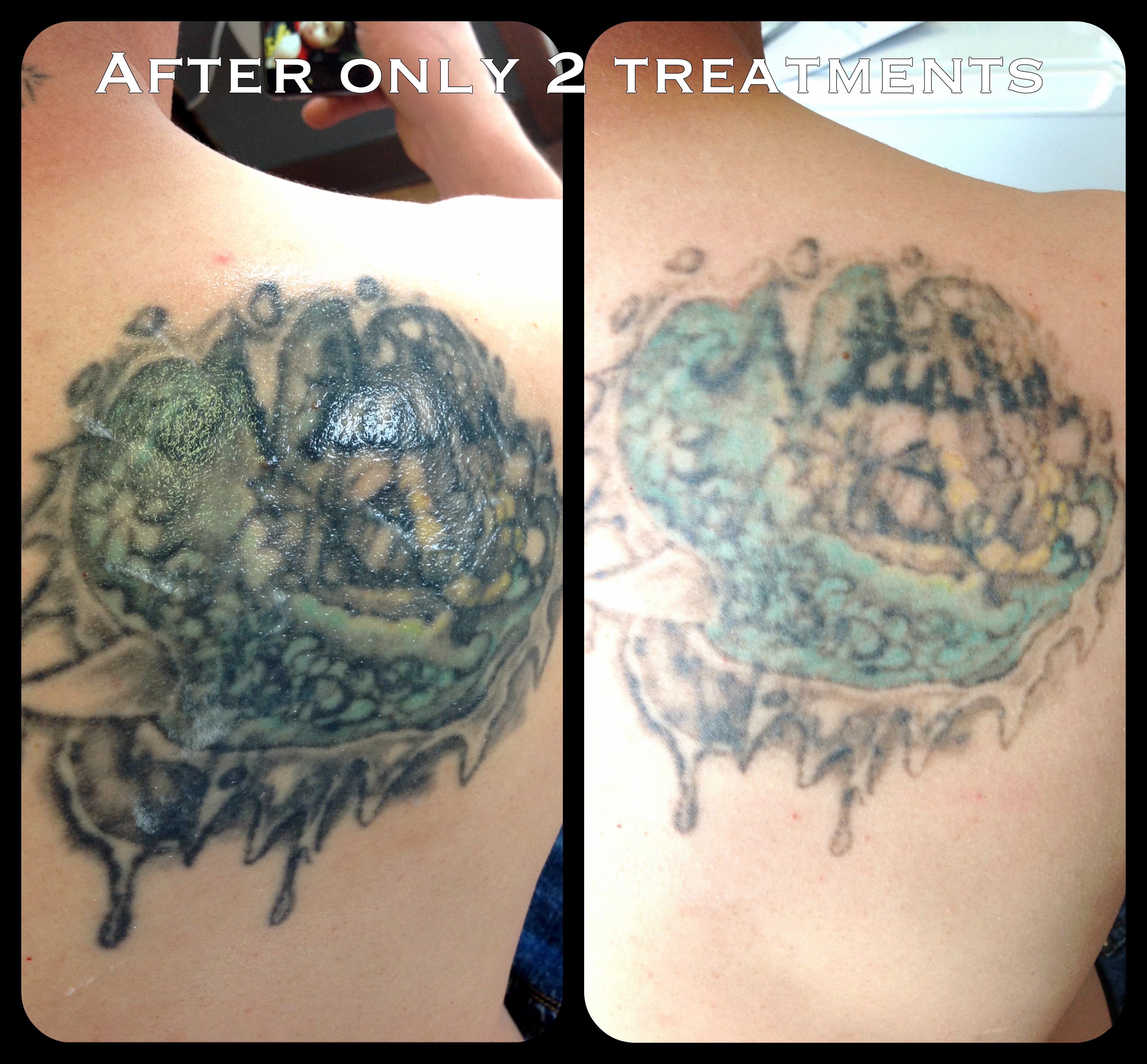 Laser tattoo removal Center, Portland cascadelaserblog